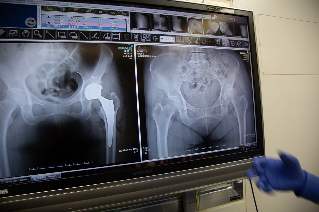 The surgical team examines a set of X-rays to confirm correct installation of the implant, the final step in a procedure lasting just 1 hour and 17 minutes. (© Ōnishi Naruaki)